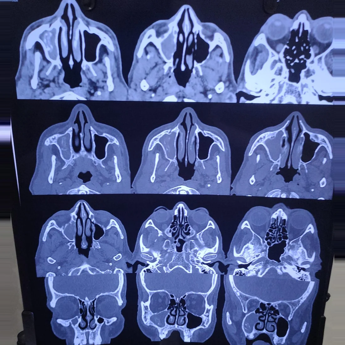 CT scan of the paranasal sinuses, used in planning endoscopic sinus surgery