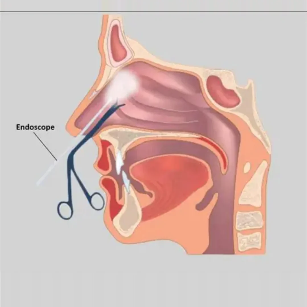 Illustration of nasal endoscopy of the nose and throat